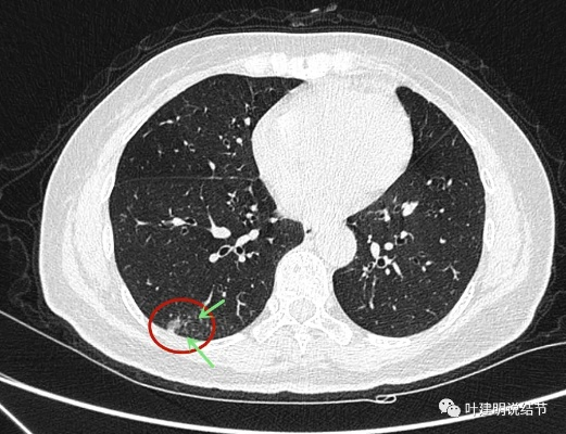 郭艾伦肺结节的良性与恶性鉴别方法及治疗建议-第2张图片-www.211178.com_果博福布斯